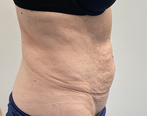 Tummy Tuck Side Before